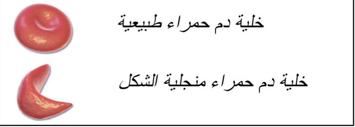 وأخيرا في كندا: توفر علاج لمرض فقر الدم المنجلي أو داء الخلية المنجلية (سيكل سل sickle cell)